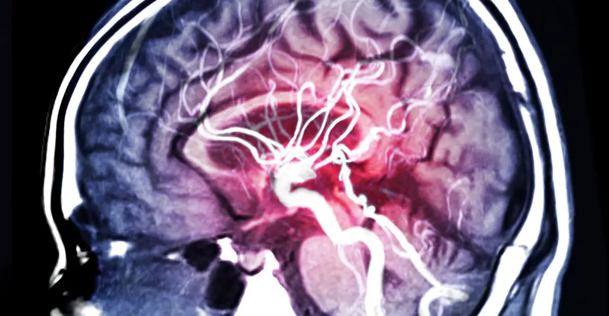 Gait recovery in a girl with ischemic spinal cord stroke